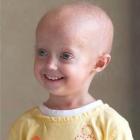 Синдром скорого старения детей