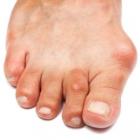 «Шишки» на пальцах ног