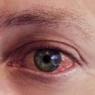 Причина красных глаз – конъюнктивит