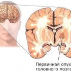 Злокачественная опухоль в  головном мозге
