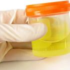 Соли в моче ребенка