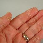 Экзема на руках – лечение есть!