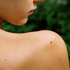 Удаление родинок и бородавок с медицинской точки зрения