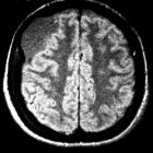 Арахноидальная киста головного мозга