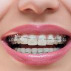 Безлигатурные брекеты