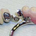 Бюгельное и нейлоновое протезирование