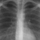 Что представляет собой рентген легких?