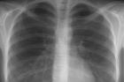Что представляет собой рентген легких?