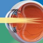 Что такое астигматизм?