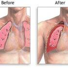 Что такое пневмоторакс?