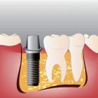 Дентальная имплантология