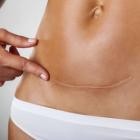 Проблемы детей и мам после кесарева