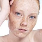 Если веснушки надоели…