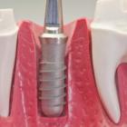 3 этапа по уходу и гигиеной после имплантации зуба