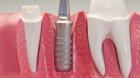 3 этапа по уходу и гигиеной после имплантации зуба