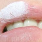 Герпес гуляет по планете