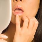 Герпес на губах: причины и лечение
