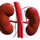 Гломерулонефрит или острый нефрит