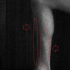 Победа над периоститом (воспалением надкостницы) - реальный опыт