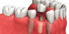 Имплантация – решение глобальных проблем зубного ряда