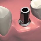 Имплантация зубов: надо ли?