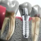 Имплантология в области стоматологии