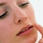 Как лечить герпес на губах?