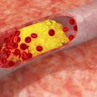 Как предупредить атеросклероз?