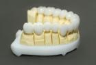 Как производится зубное протезирование?