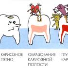 Как развивается кариес?