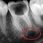 Как удаляется киста зуба?