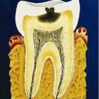 Когда появляется кариес?