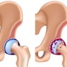 Коксартроз или нарушение функционирования сустава