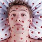 Корь – острое инфекционное заболевание