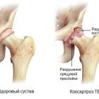 Лечение тазобедренного сустава