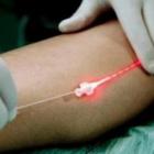 Лечение варикозного расширения вен лазером