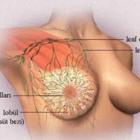 Мастопатия груди: как не дать болезни ни одного шанса