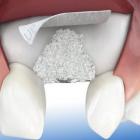 Материалы для имплантации зубов