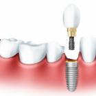 Метод имплантации зубов