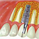 Методы и виды имплантации зубов