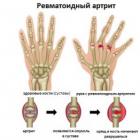 Методы лечения артрита