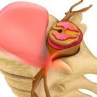 Межпозвонковая грыжа: причины возникновения