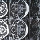 Межпозвоночная грыжа: этапы, симптомы, лечение