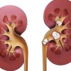 Мочекаменная болезнь