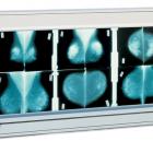 Негатоскоп – анализатор рентгеновских снимков