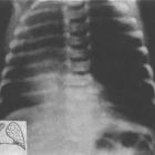 Об эмфиземе легких