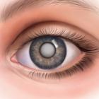 Определение и лечение катаракты