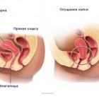 Опущение влагалища