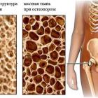 Проблема остеопороза