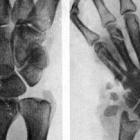 Перелом ладьевидной кости